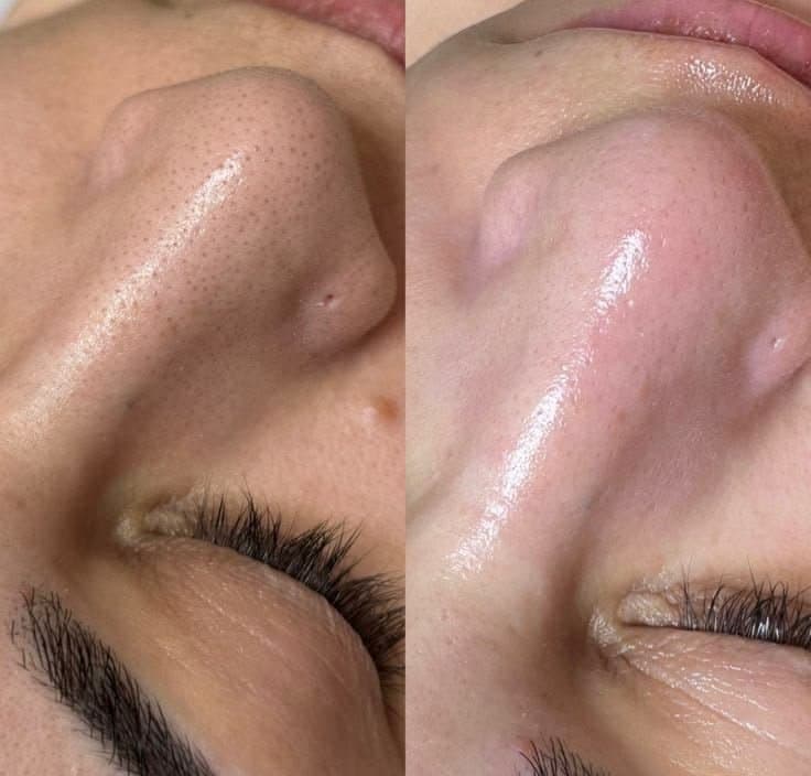 Hydrafacial öncesi ve sonrası – By Nur Rana Klinik, Karatay/Konya