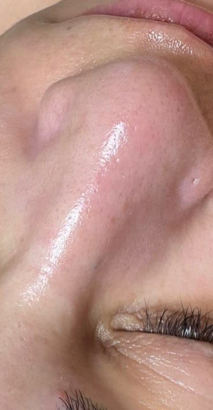 Hydrafacial
