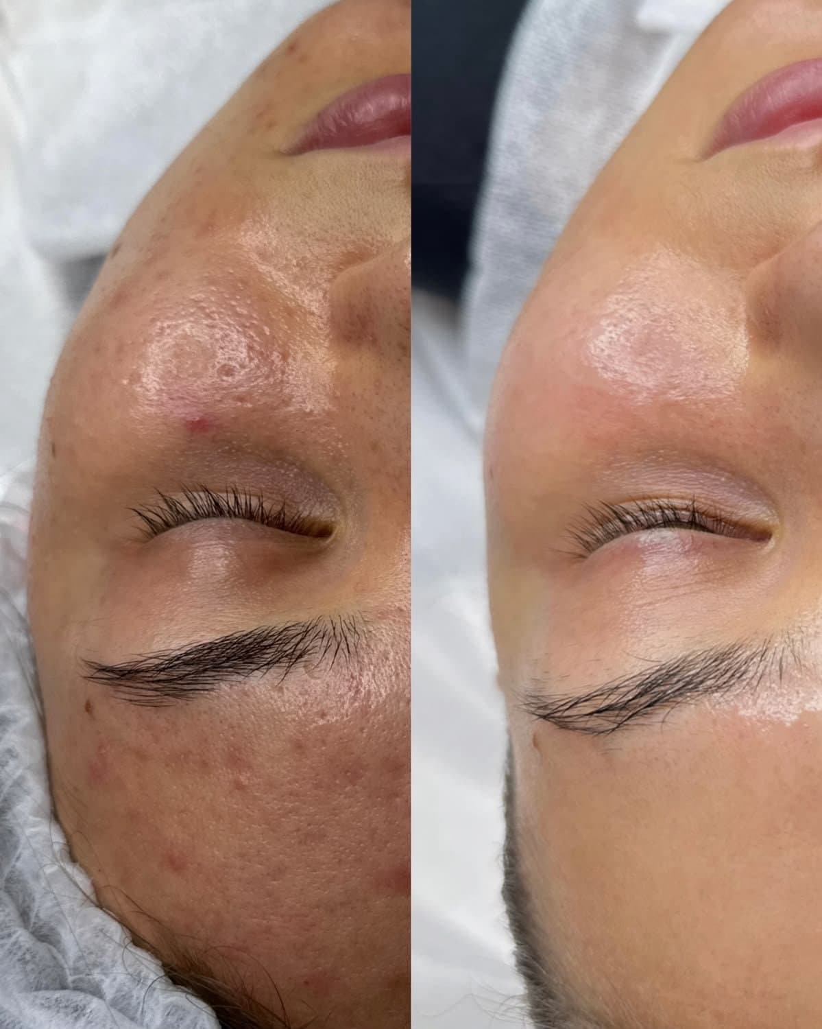 Leke Protokolleri öncesi ve sonrası – By Nur Rana Klinik, Karatay/Konya